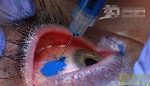 Eyeball tatoo opération