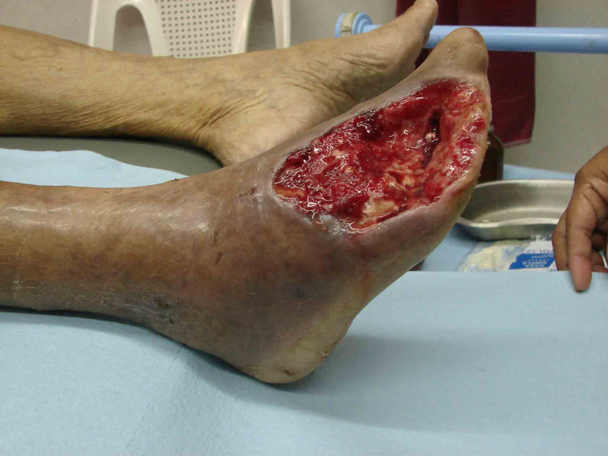 Le-Krokodil-la-nouvelle-drogue-aux-effets-devastateurs