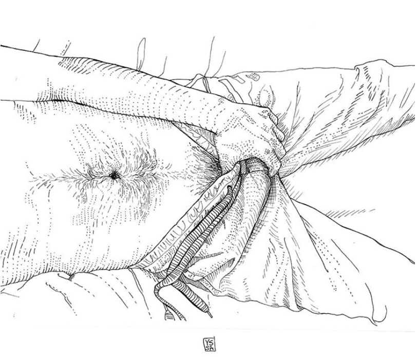 Yssa 11
